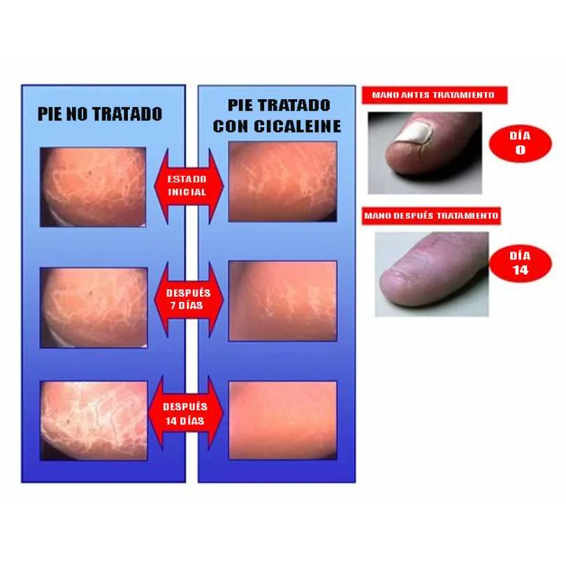 Cicaleine fisuras pies y manos